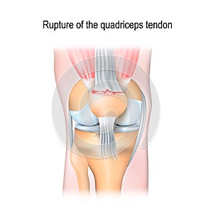 Rupture of the quadriceps tendon photo