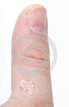 Ruptured blister on thumb