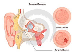 Ruptured eardrum. Anatomy of the human ear. Healthy and perforated