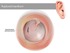 Ruptured eardrum or perforated eardrum. Tympanic membrane perforation.