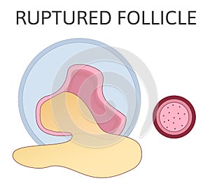 Ruptured follicle. Stage of developing follicle. Ovulation