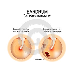 Ruptured perforated eardrum