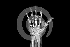 Rx image of left hand of adolescent for bone age.
