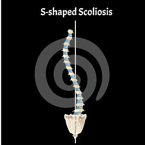 S-shaped scoliosis. Dextroscoliosis. Levoscoliosis. Spinal curvature, kyphosis, lordosis, scoliosis, arthrosis