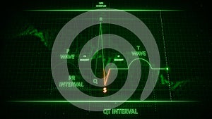 S Wave from Electrocardiogram Wave or ECG or EKG photo