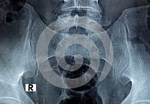 Sacroiliac joint digital radiograph examination X-ray reveals preserved sacroiliac joints spaces and smooth articular surfaces,