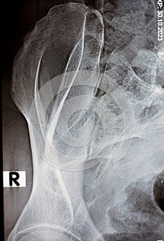 Sacroiliac joint digital radiograph examination X-ray reveals preserved sacroiliac joints spaces and smooth articular surfaces,