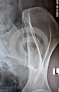 Sacroiliac joint digital radiograph examination X-ray reveals preserved sacroiliac joints spaces and smooth articular surfaces,