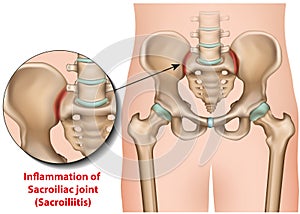 Sacroiliac joint inflammation 3d medical  illustration sacroiliitis