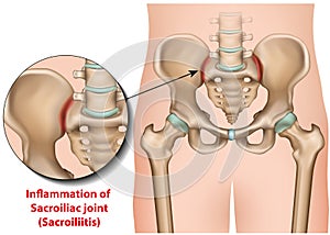 Sacroiliac joint inflammation 3d medical  illustration sacroiliitis photo