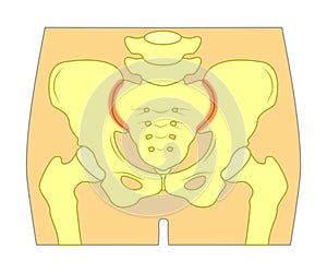 Sacroiliac Joint Pain photo