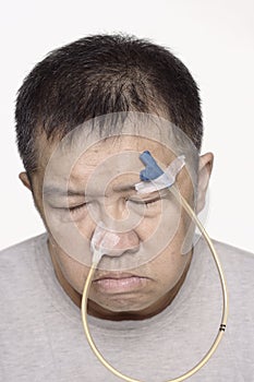 Sad chinese man with nasogastric tube