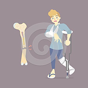 Sad patient with cast on broken leg and arm bone holding crutch, walking aid, internal organs body part orthopedic health care