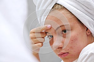 A sad teenage girl is looking at the pimples on her face in the mirror. Problematic skin. Acne