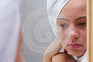A sad teenage girl is looking at the pimples on her face in the mirror. Problematic skin in adolescents