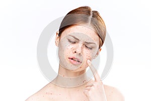 sad woman with bare shoulders red dots on her face
