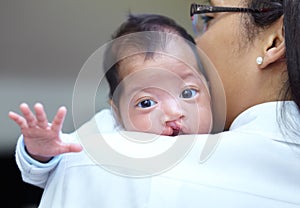 She is safe in her mothers arms. Portrait of a baby girl who has a cleft palate looking over the shoulder of her mother.