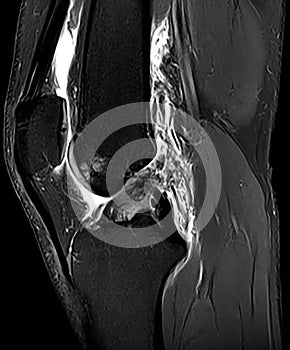 Sagital PD FS MRI of Knee photo