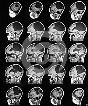 Sagittal brain mri