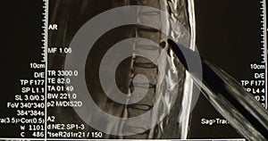 A Sagittal View Magnetic Resonance Image or MRI of Lumbar Spine Showing Ruptured Intervertebral Disc Herniation