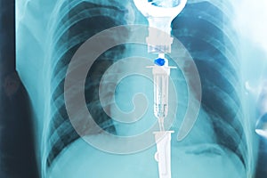 Saline drip medical,IV Drip Solution, Intravenous Treatment for Hospital Patients,coronavirus or covid-19 concept,Lung X-ray Film