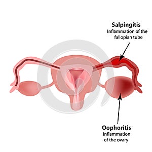 Salpingitis. Inflammation of the fallopian tube. Oophoritis. Inflammation of the ovary. pelvic organs. Infographics photo