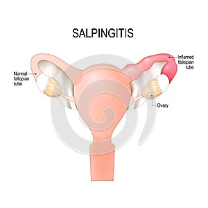 Salpingitis. inflammation in the Fallopian tubes.