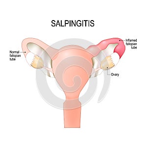 Salpingitis. inflammation in the Fallopian tubes. photo