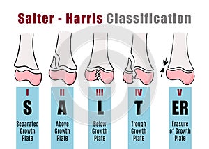 Salter - Harris classification to to recognize and identify different types of bone fractures