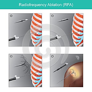 Radio frequency Ablation RFA. Illustration info graphic medical. photo