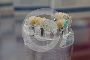 Samples of implants and dentures and dental bridges, demonstration on an artificial jaw