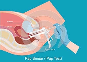Sampling the endocervix using the cervical brush