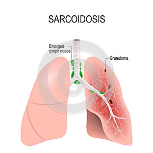 Sarcoidosis. Human`s lungs with granulomas