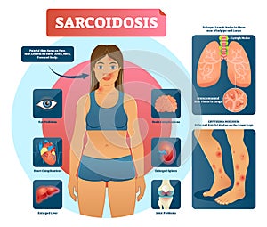 Sarcoidosis vector illustration. Lungs, heart, eyes autoimmune disease