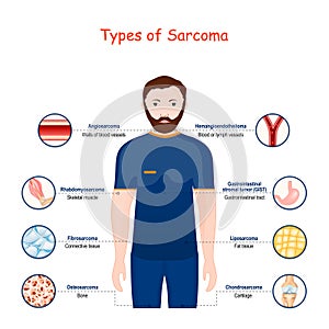 Sarcoma. Types of a malignant tumor. cancer photo