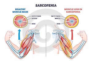 Sarcopenia as muscle mass loss and fatty tissue growth outline diagram