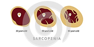 Sarcopenia in elderly. Replacement of muscle tissue