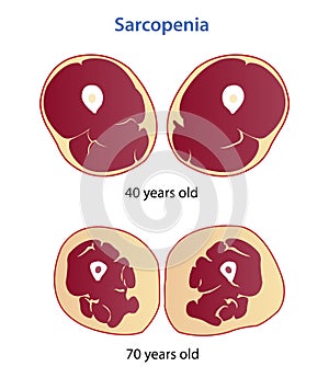 Sarcopenia, loss muscle mass and strength vector illustration. photo
