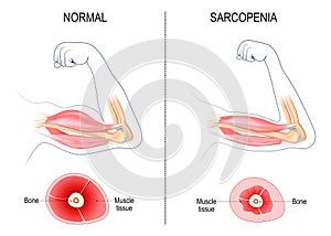 sarcopenia. muscle atrophy