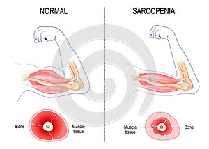 sarcopenia. muscle atrophy photo