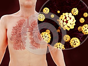 Sars disease, coronaviruses in the lung