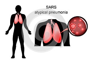SARS. inflamed lungs and the causative agent photo