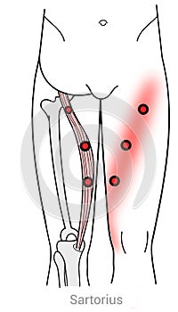 MyofasciaTrigger points in the Sartorius thigh muscle photo