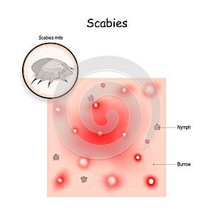 Scabies. contagious skin infestation