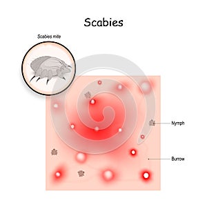 Scabies. contagious skin infestation photo