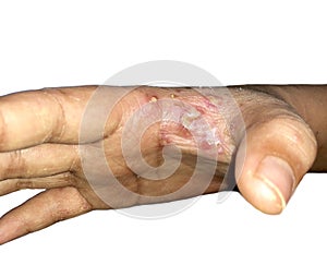 Scabies Infestation with secondary bacterial infection or pustules in right hand of Southeast Asian, Burmese Child in Myanmar.