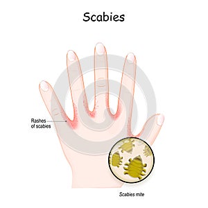 Scabies mite. Human`s hand. skin with Rashes photo