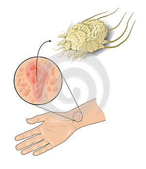 Scabies photo