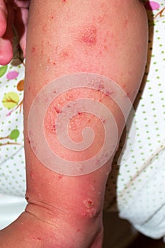 Scabies skin lesions