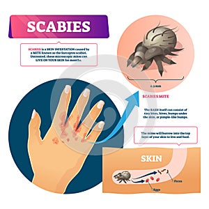 Scables vector illustration. Labeled educational skin infestation scheme.